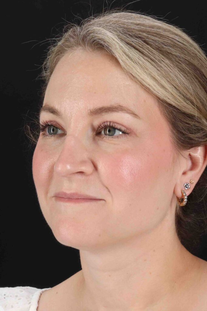 After - left_oblique