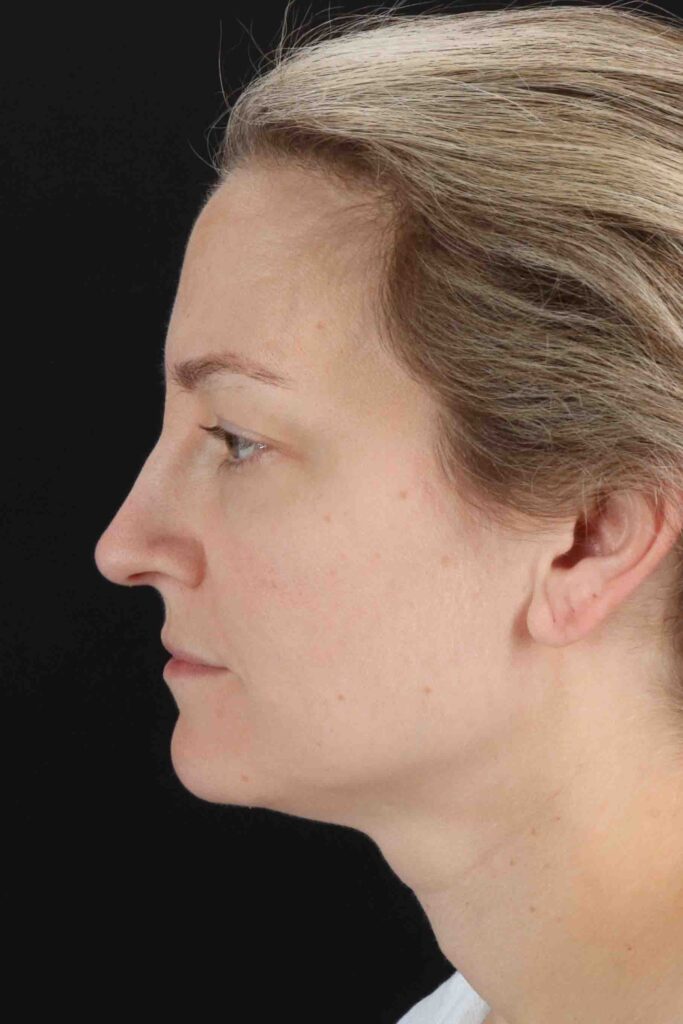 Before - left_lateral