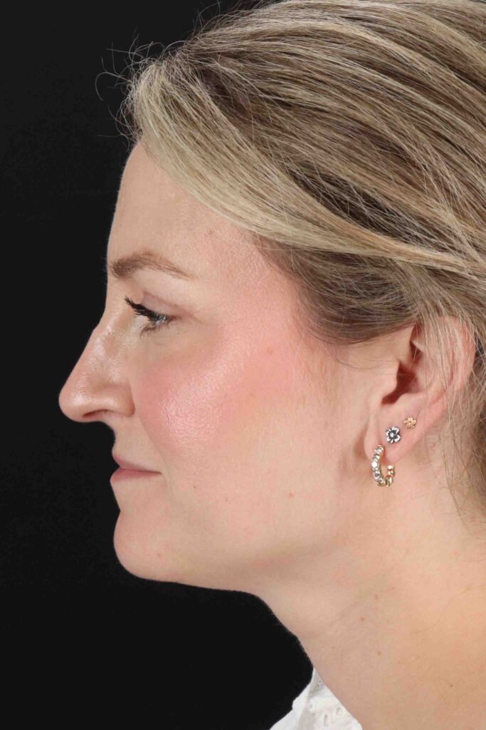 After - left_lateral