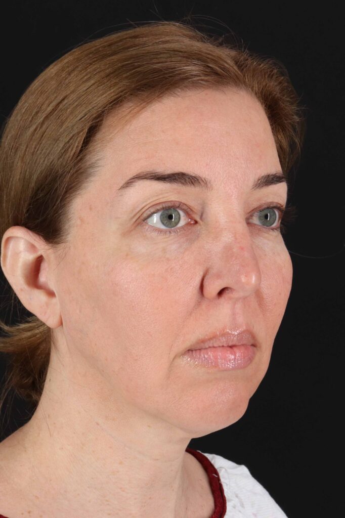 Before - right_oblique