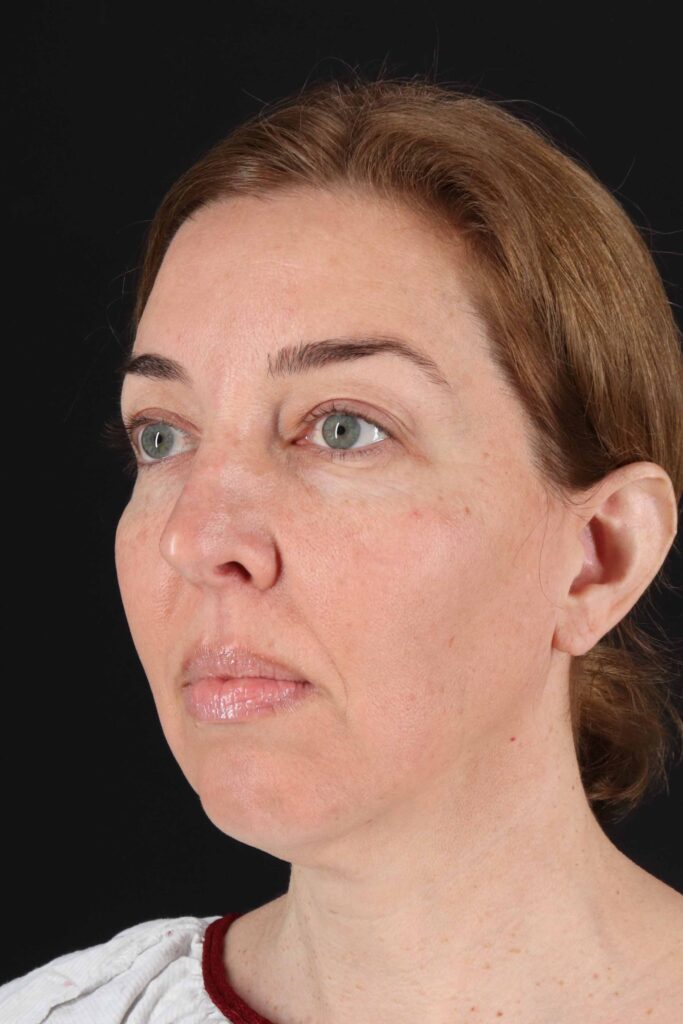 Before - left_oblique