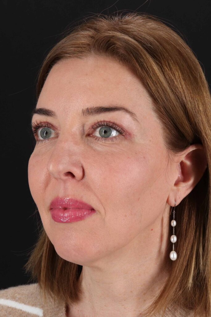 After - left_oblique