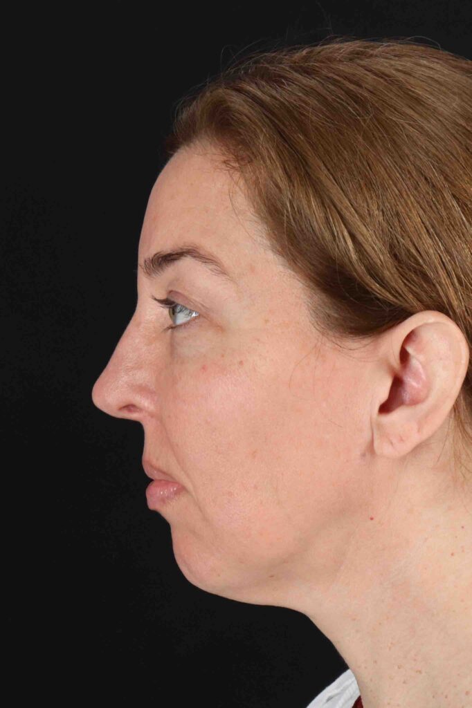 Before - left_lateral