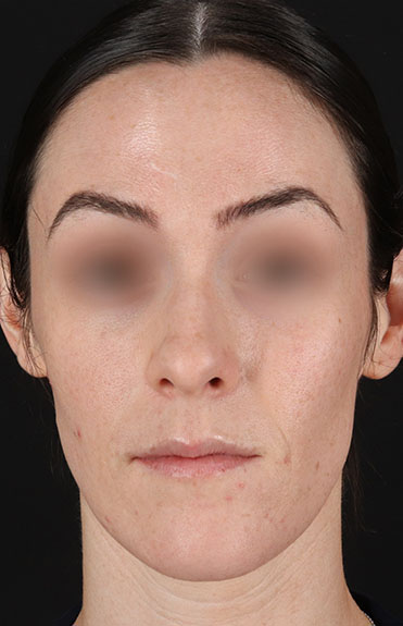 Before - front_alt_1