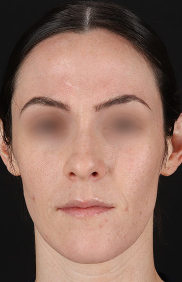 Before - front_alt_2