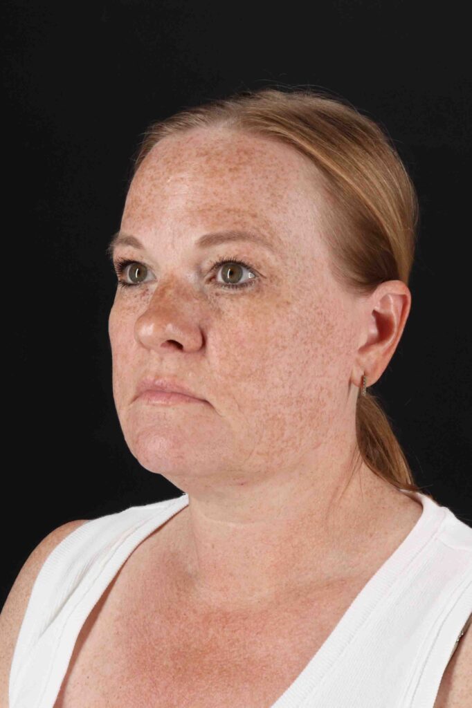 Before - left_oblique