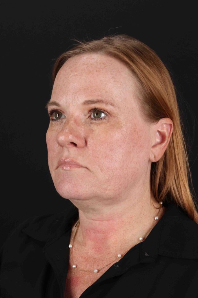 After - left_oblique