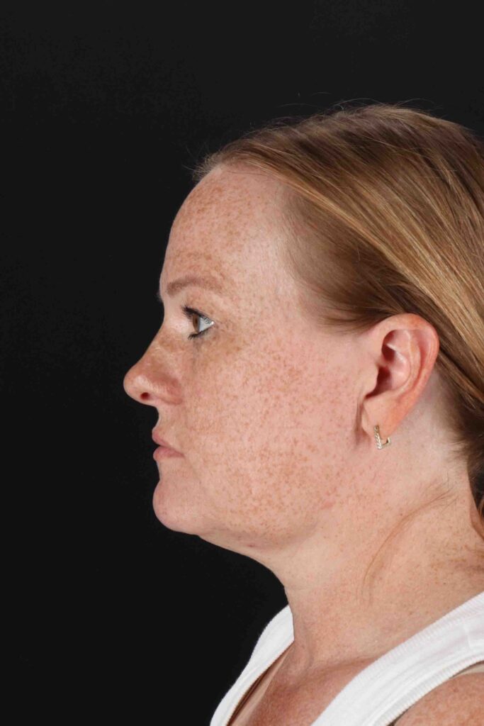 Before - left_lateral