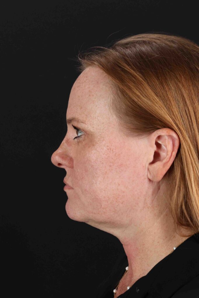 After - left_lateral