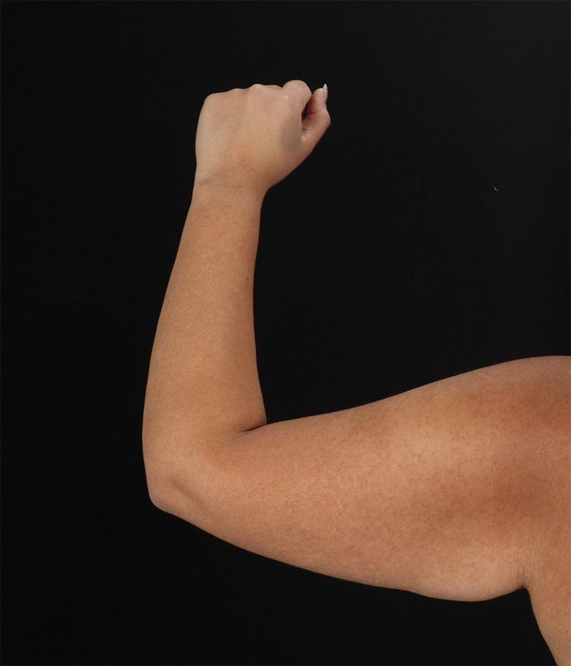 Before - left_lateral