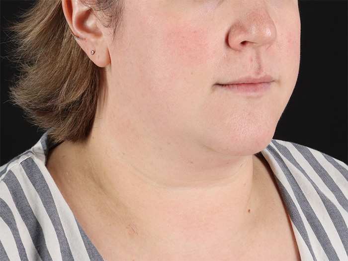 Before - right_oblique