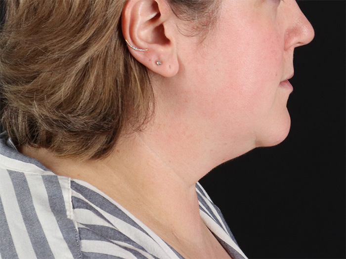 Before - right_lateral