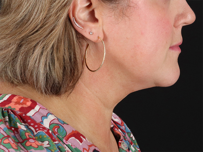 After - right_lateral