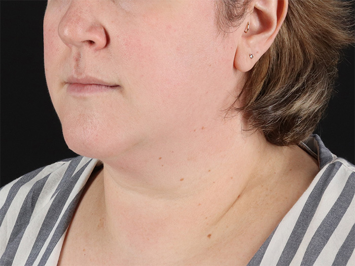 Before - left_oblique