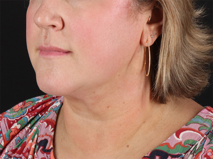 After - left_oblique