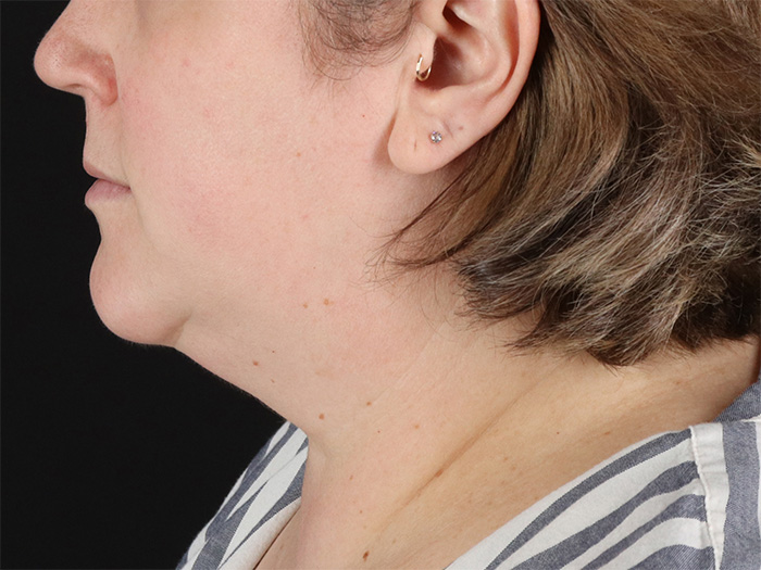 Before - left_lateral