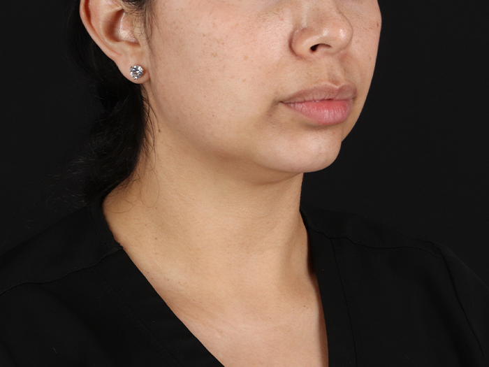 Before - right_oblique