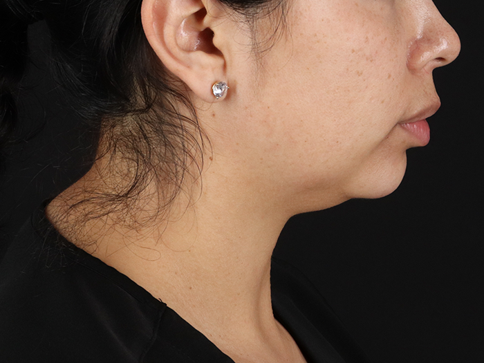 Before - right_lateral