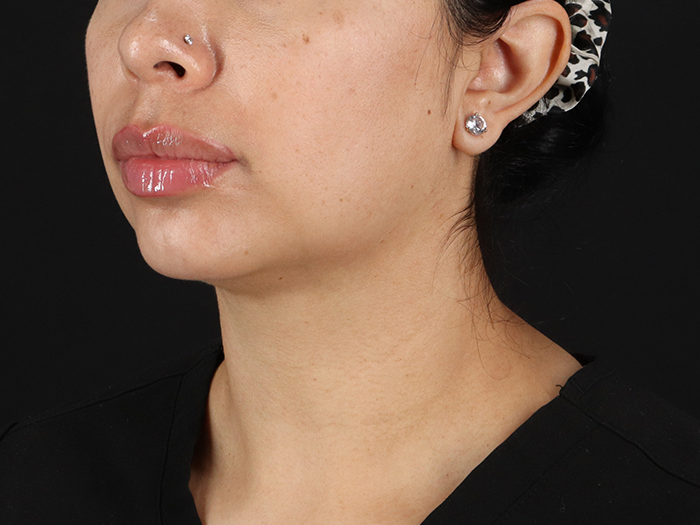 After - left_oblique