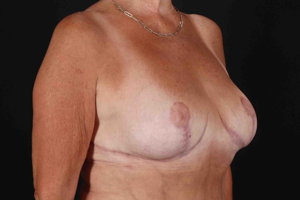 After - right_oblique