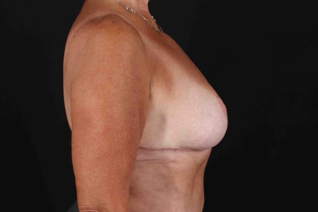 After - right_lateral