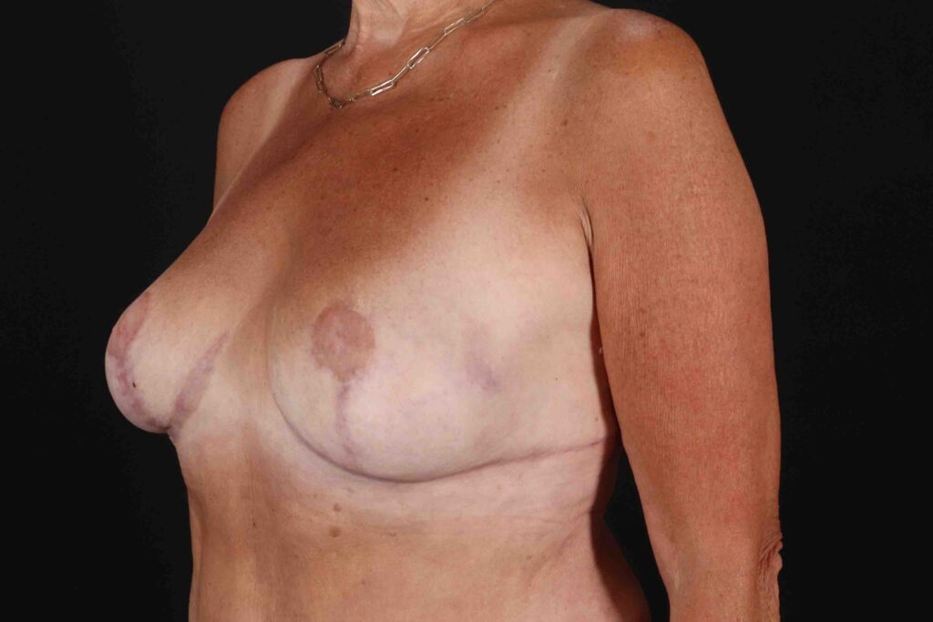 After - left_oblique