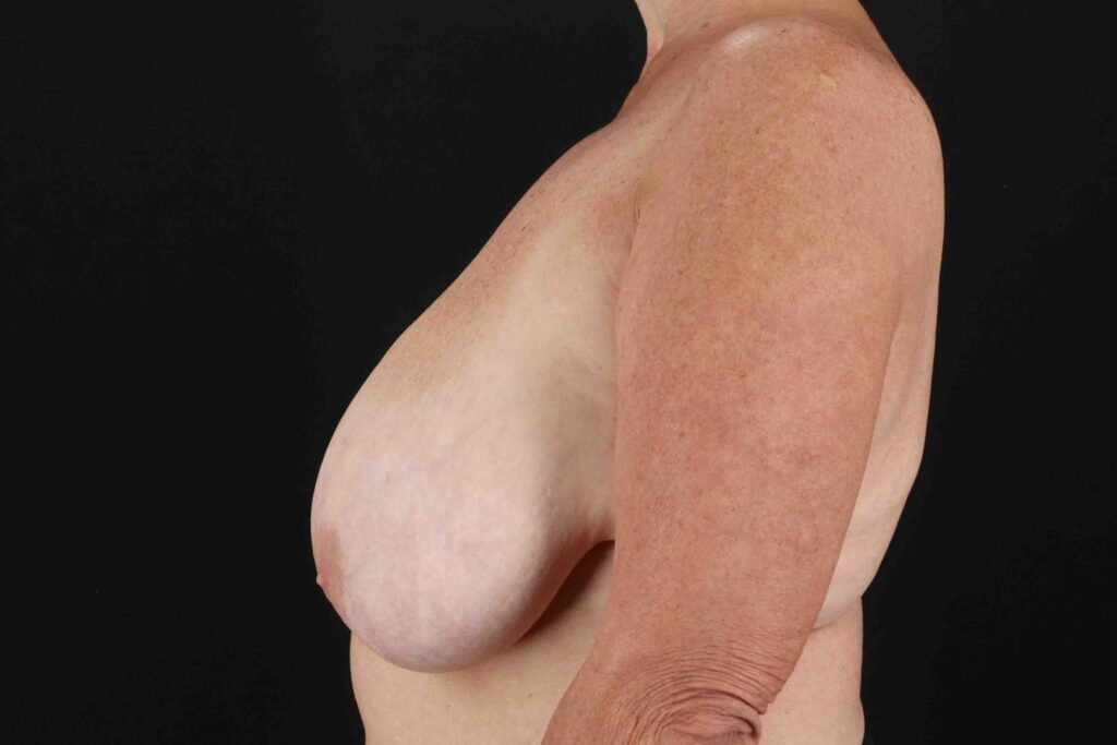 Before - left_lateral