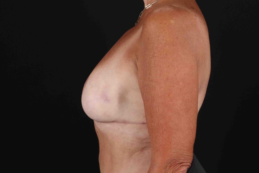 After - left_lateral