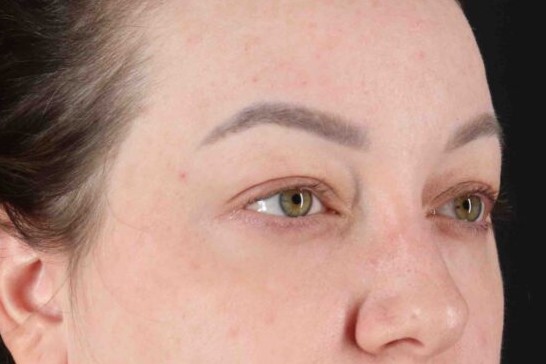 Before - right_oblique