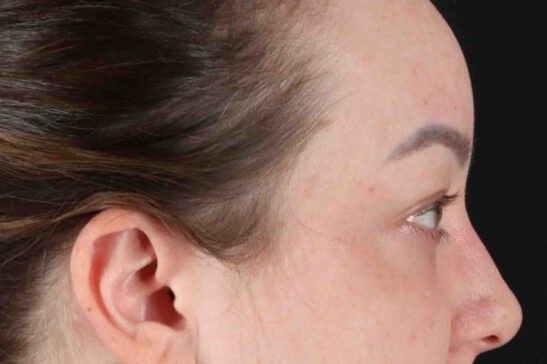 Before - right_lateral