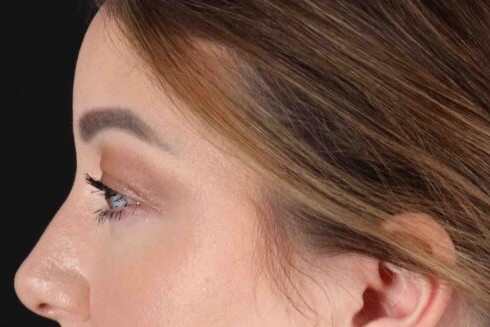 After - left_lateral